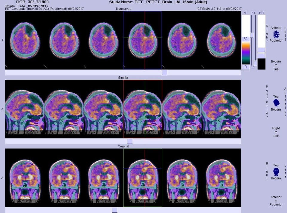 Glioblastoma, iperattività mitocondriale, tumore al cervello, tumori cerebrali, cancro, Fondazione Bartolo Longo,